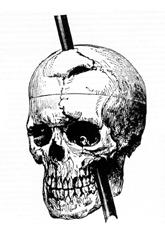 Illustration of Phineas Gage's injury