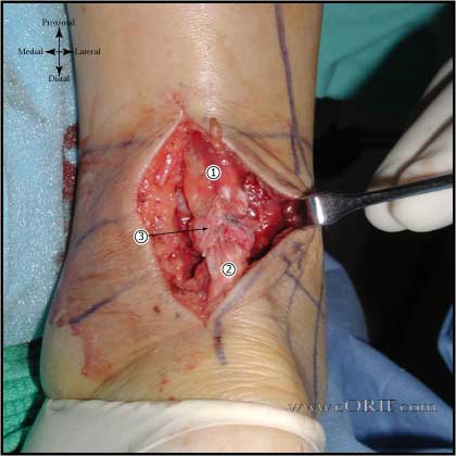 It would be nice to know before your tendon looks like this. Unfortunately, achilles tendon ruptures often occur suddenly with no prior warning.