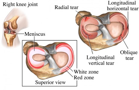 Most meniscus injuries do not repair themselves. That being said, many people go on to be symptom free after a meniscus tear.