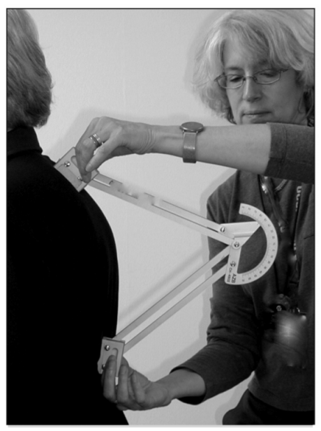 katzman hyperkyphosis